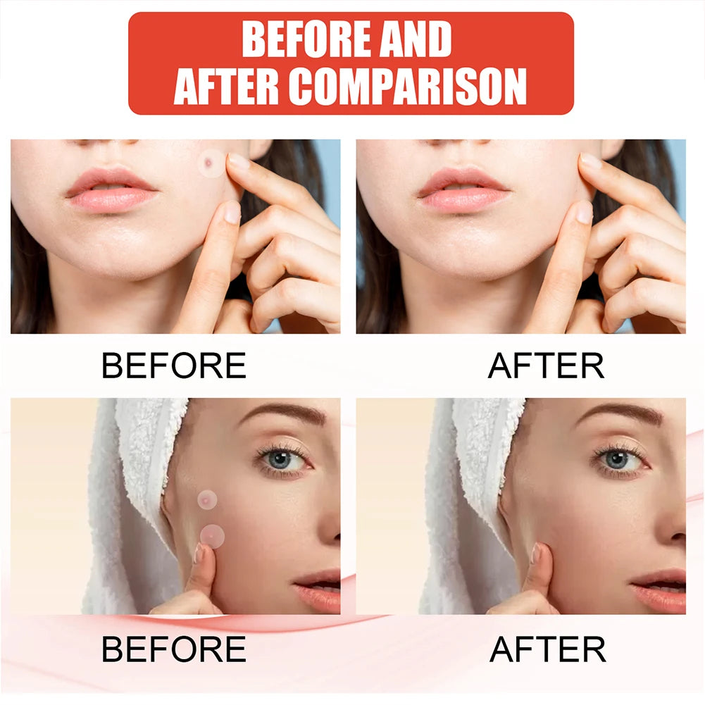 PIMPLE PATCH